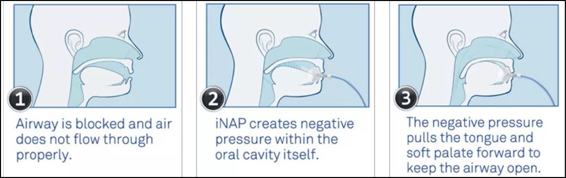 Anti-Snoring Sleep Apnea Device - SMIT Medical